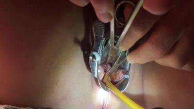 Tenaculum Grasping Cervix For Catheter 7 Min - hclips.com